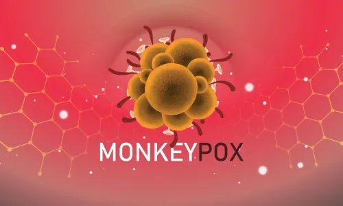 Monkeypox Ireland: Things You Should Know